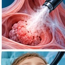 Medical illustration of Bronchoscopic thermal vapor ablation for severe emphysema